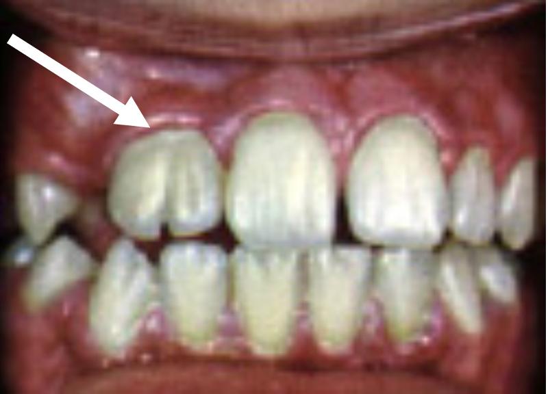 Gemination 1.2 Clinical Arrow.jpg